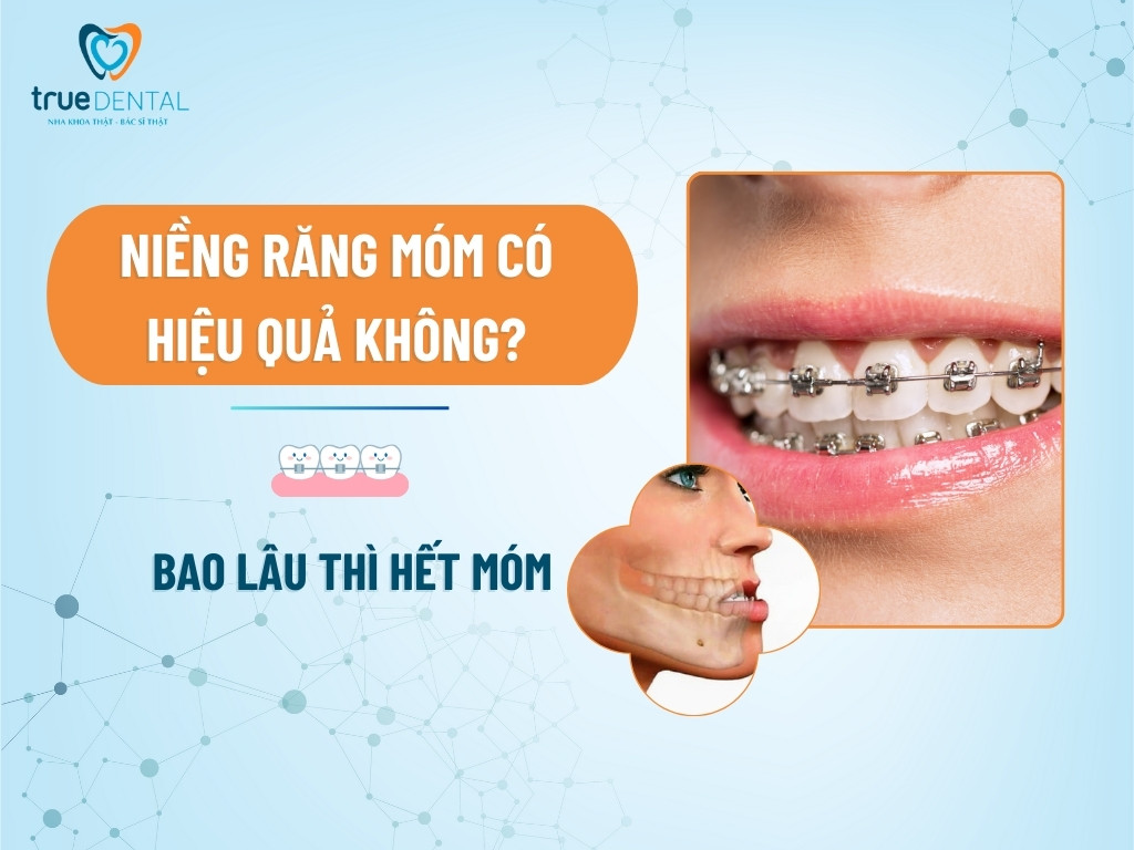 NIỀNG RĂNG MÓM CÓ HIỆU QUẢ KHÔNG? BAO LÂU THÌ HẾT MÓM