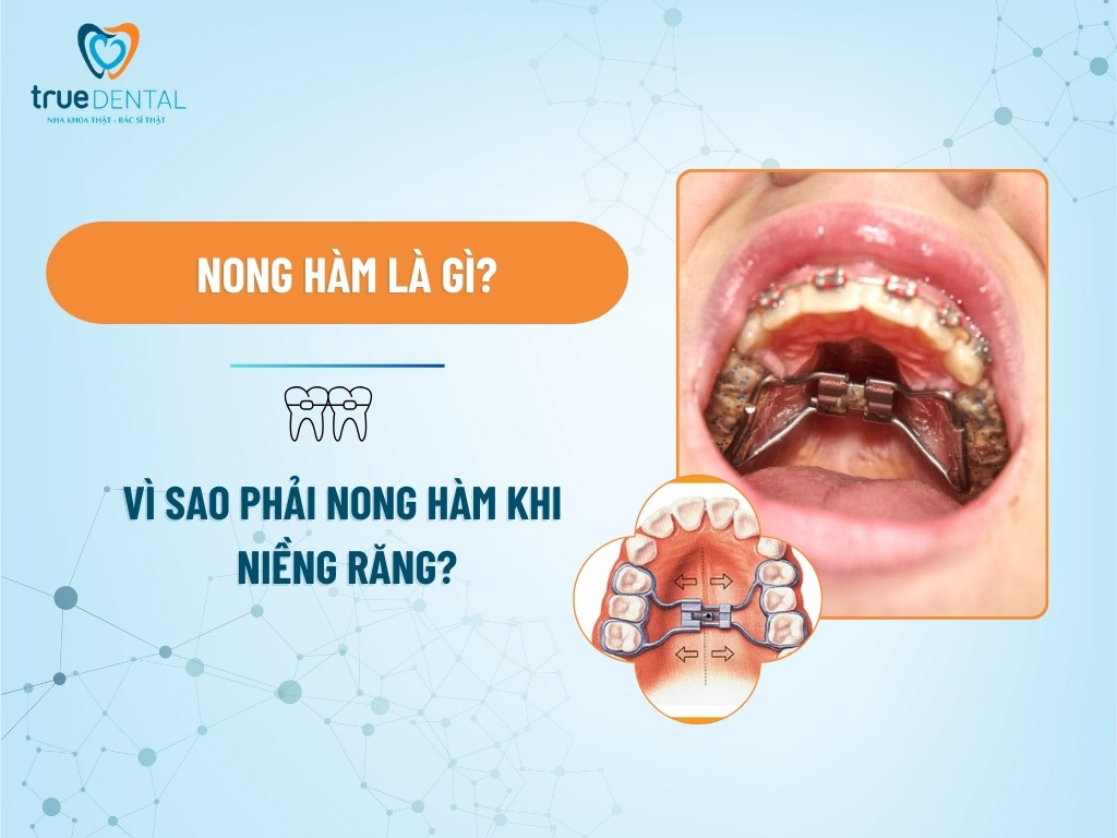 NONG HÀM LÀ GÌ? VÌ SAO PHẢI NONG HÀM KHI NIỀNG RĂNG?