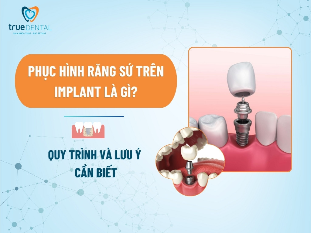 PHỤC HÌNH RĂNG SỨ TRÊN IMPLANT LÀ GÌ? QUY TRÌNH VÀ LƯU Ý CẦN BIẾT
