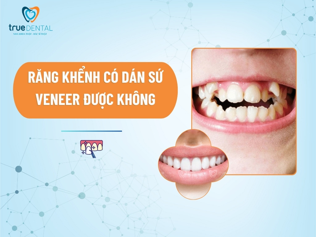 [GIẢI ĐÁP] RĂNG KHỂNH CÓ DÁN SỨ VENEER ĐƯỢC KHÔNG?