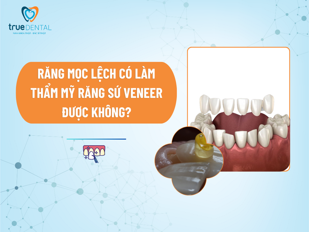 [GIẢI ĐÁP] RĂNG MỌC LỆCH CÓ LÀM THẨM MỸ RĂNG SỨ VENEER ĐƯỢC KHÔNG?