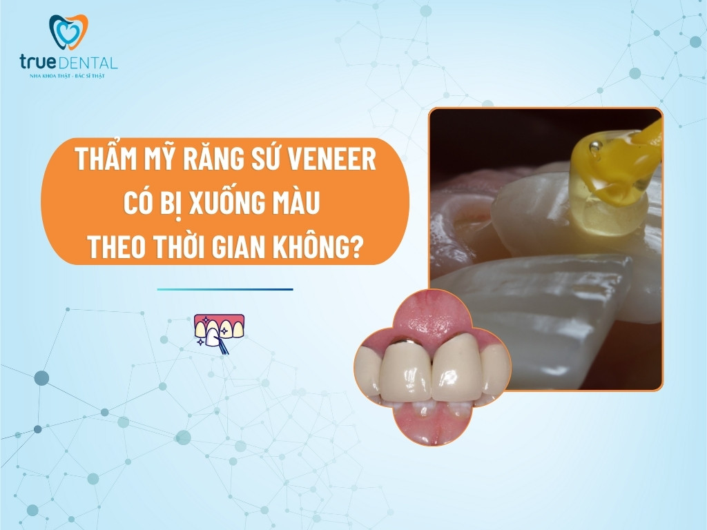 THẨM MỸ RĂNG SỨ VENEER CÓ BỊ XUỐNG MÀU THEO THỜI GIAN KHÔNG?