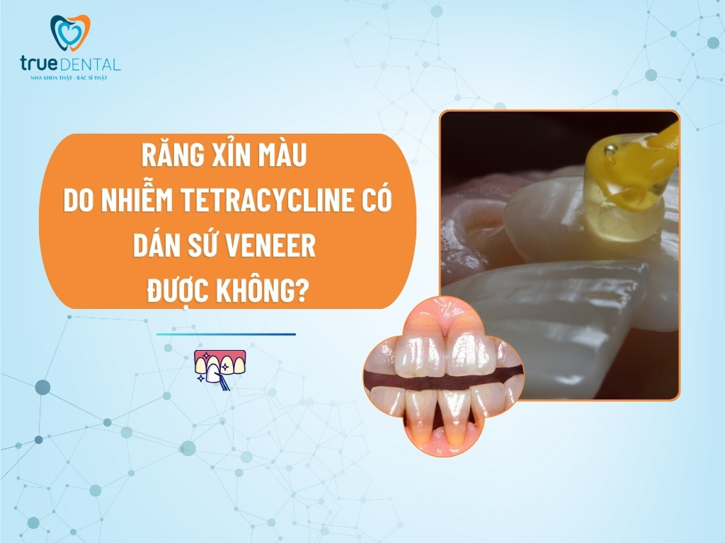 RĂNG XỈN MÀU DO NHIỄM TETRACYCLINE CÓ DÁN SỨ VENEER ĐƯỢC KHÔNG?