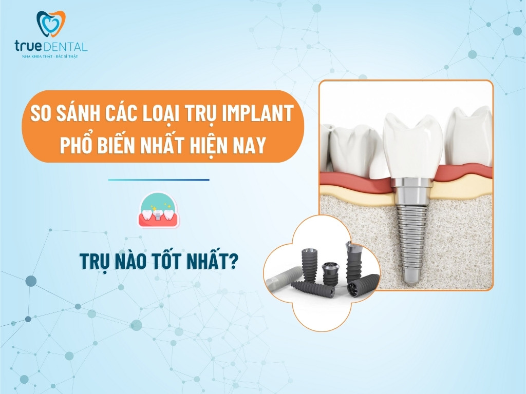 SO SÁNH CÁC LOẠI TRỤ IMPLANT PHỔ BIẾN NHẤT HIỆN NAY: TRỤ NÀO TỐT NHẤT?