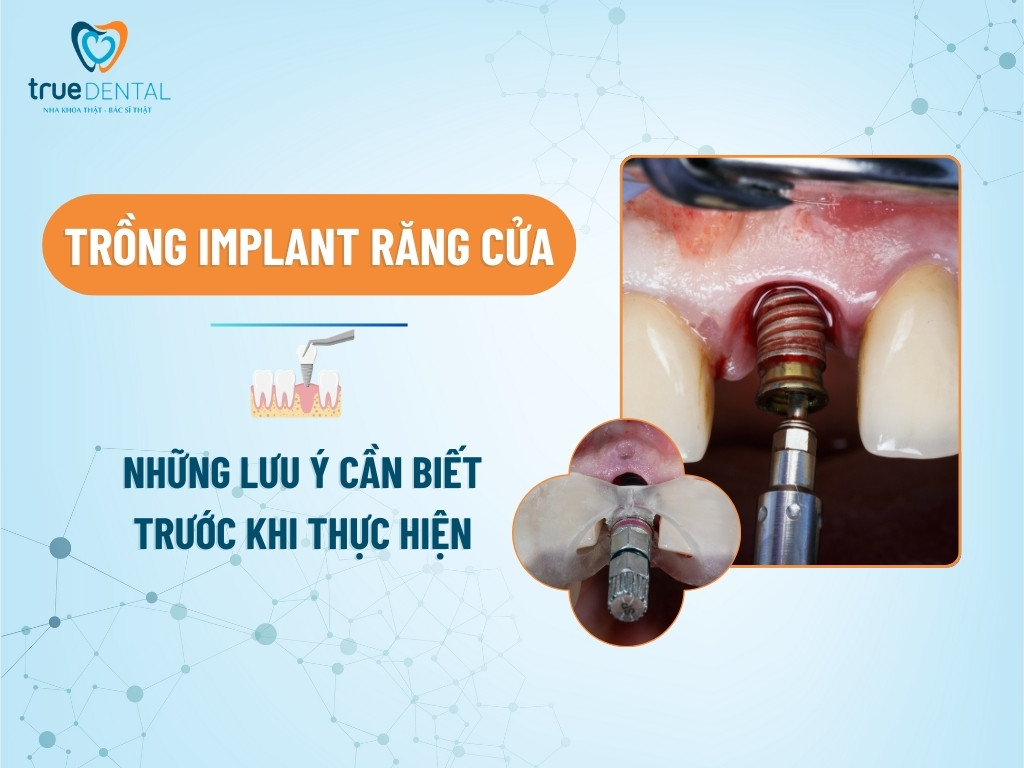 TRỒNG IMPLANT RĂNG CỬA: NHỮNG LƯU Ý CẦN BIẾT TRƯỚC KHI THỰC HIỆN