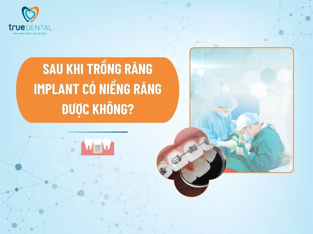 [GIẢI ĐÁP] SAU KHI TRỒNG RĂNG IMPLANT CÓ NIỀNG RĂNG ĐƯỢC KHÔNG?