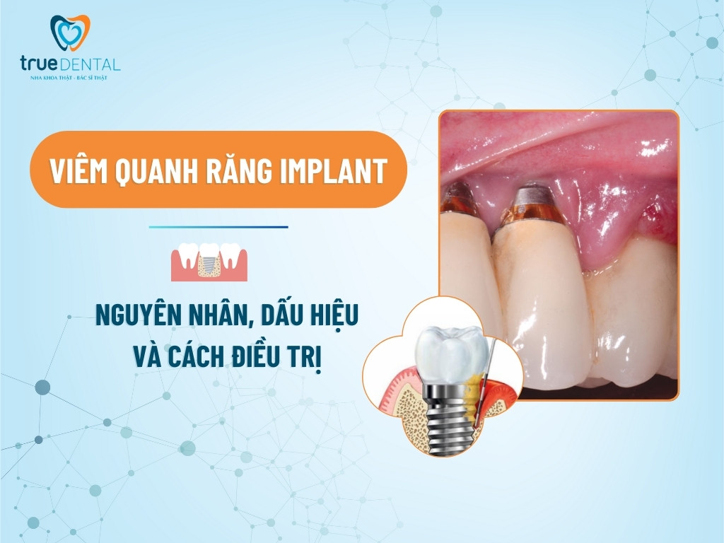 VIÊM QUANH RĂNG IMPLANT: NGUYÊN NHÂN, DẤU HIỆU VÀ CÁCH ĐIỀU TRỊ
