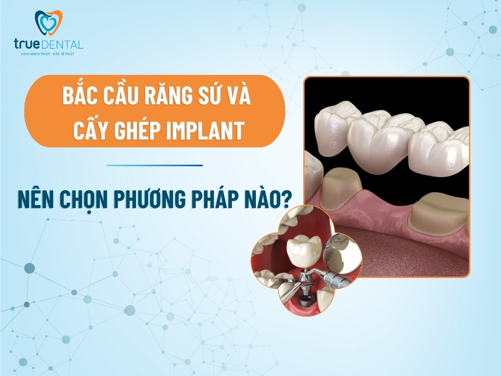 bac cau rang su va cay ghep implant 1