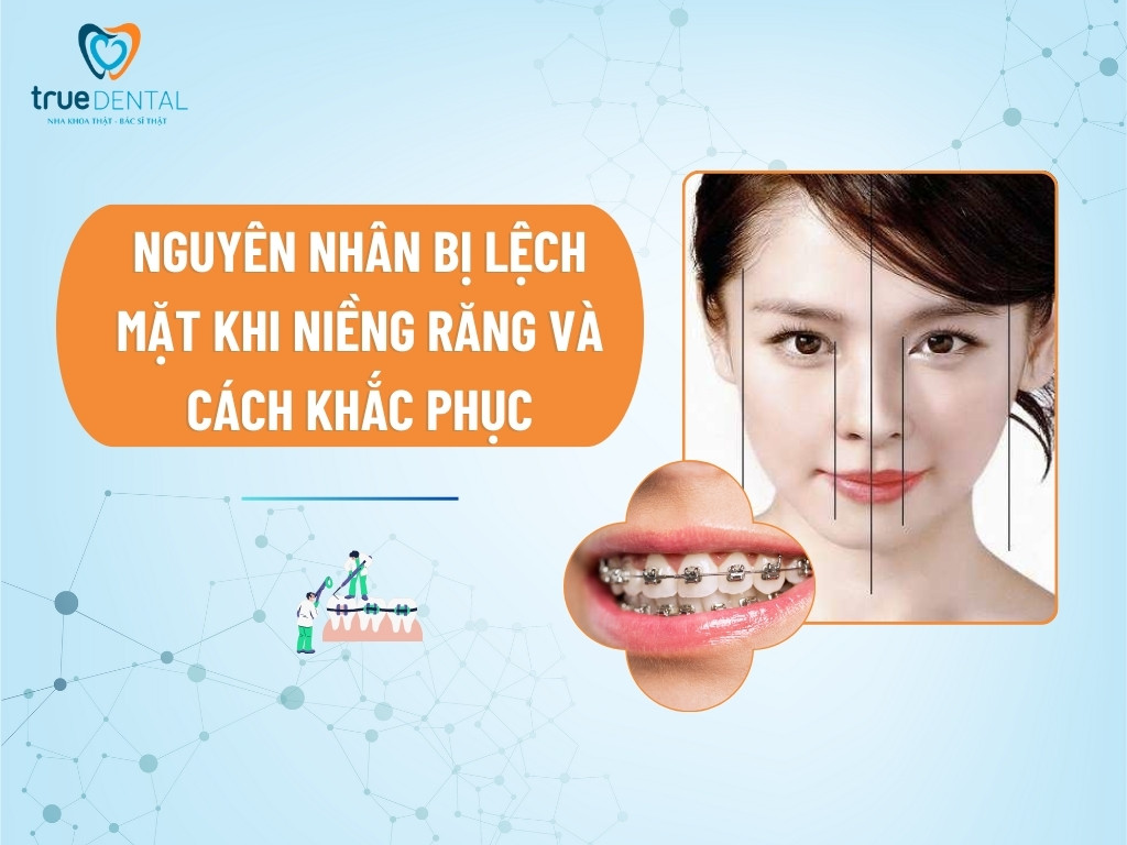 NGUYÊN NHÂN BỊ LỆCH MẶT KHI NIỀNG RĂNG VÀ CÁCH KHẮC PHỤC 4 NGUYÊN NHÂN BỊ LỆCH MẶT KHI NIỀNG RĂNG VÀ CÁCH KHẮC PHỤC