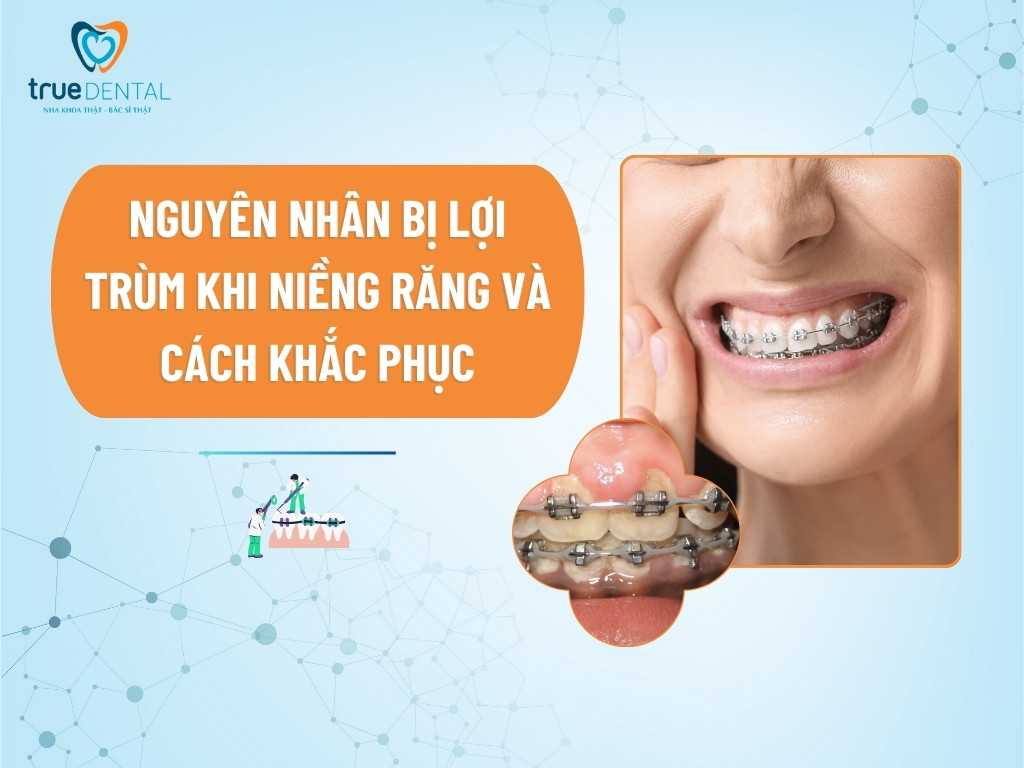 NGUYÊN NHÂN BỊ LỢI TRÙM KHI NIỀNG RĂNG VÀ CÁCH KHẮC PHỤC