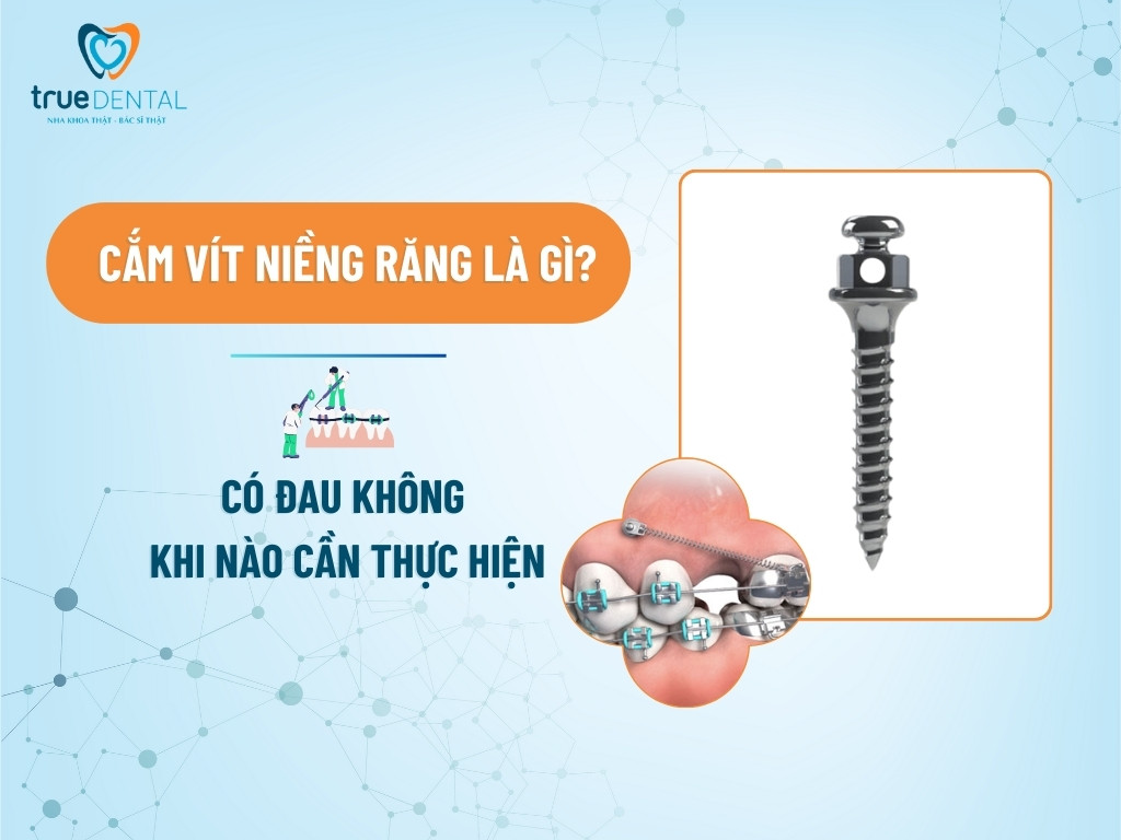 CẮM VÍT NIỀNG RĂNG LÀ GÌ? CÓ ĐAU KHÔNG VÀ KHI NÀO CẦN THỰC HIỆN