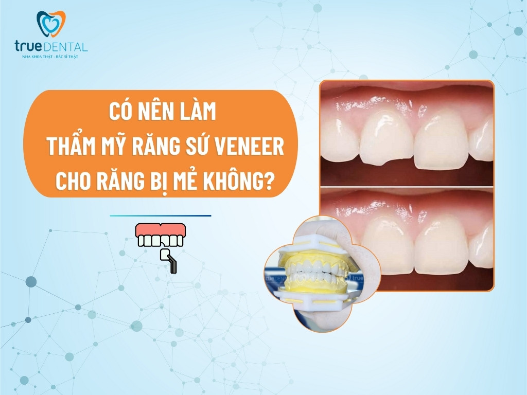 [GIẢI ĐÁP] CÓ NÊN LÀM THẨM MỸ RĂNG SỨ VENEER CHO RĂNG BỊ MẺ KHÔNG?