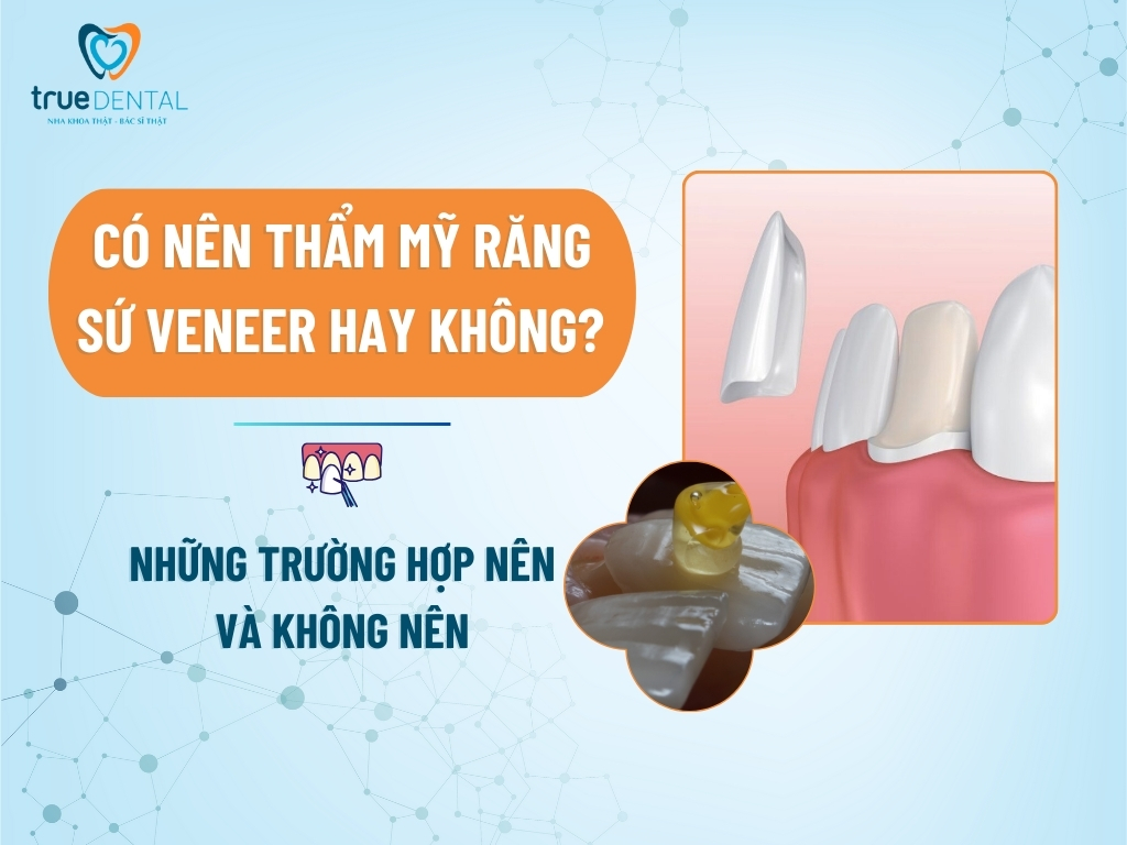 co nen tham my rang su veneer hay khong 1