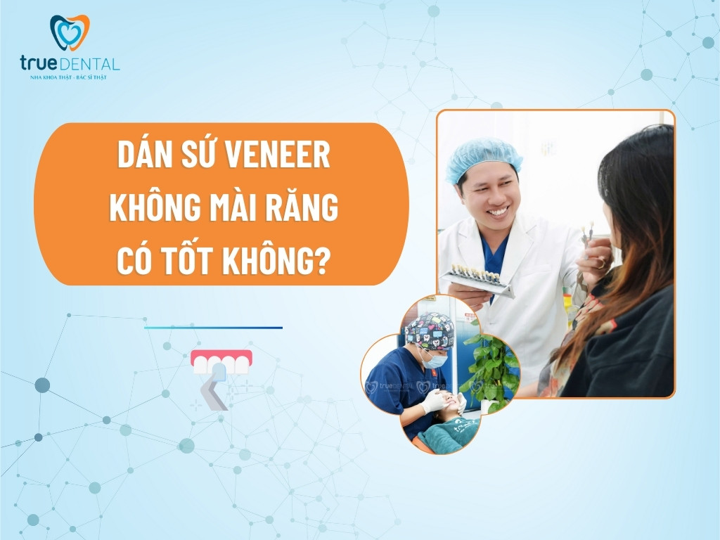[GIẢI ĐÁP] DÁN SỨ VENEER KHÔNG MÀI RĂNG CÓ TỐT KHÔNG?