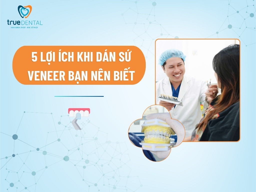 5 LỢI ÍCH KHI DÁN SỨ VENEER BẠN NÊN BIẾT