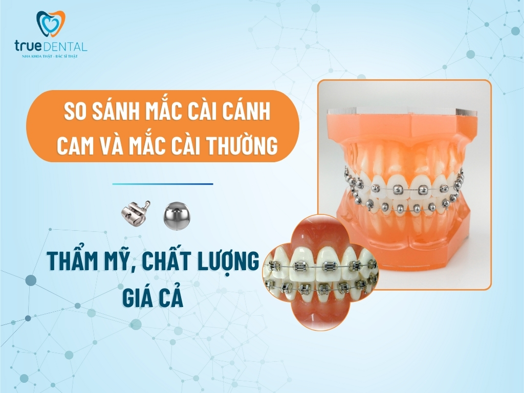 So sánh mắc cài cánh cam và mắc cài thường: thẩm mỹ, chất lượng, giá cả 10 SO SÁNH MẮC CÀI CÁNH CAM VÀ MẮC CÀI THƯỜNG: THẨM MỸ, CHẤT LƯỢNG, GIÁ CẢ