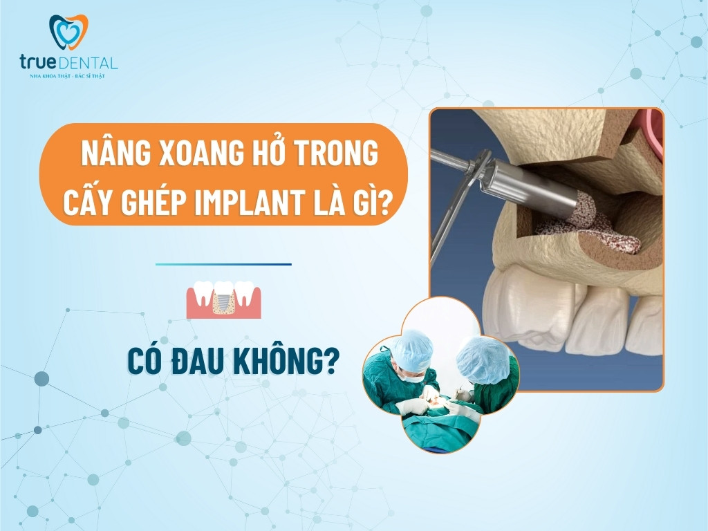 NÂNG XOANG HỞ TRONG CẤY GHÉP IMPLANT LÀ GÌ? CÓ ĐAU KHÔNG?