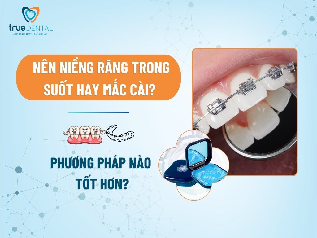 NÊN NIỀNG RĂNG TRONG SUỐT HAY MẮC CÀI? PHƯƠNG PHÁP NÀO TỐT HƠN? 9 nen nieng rang trong suot hay mac cai 1