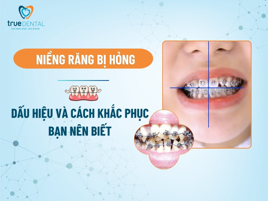 NIỀNG RĂNG BỊ HỎNG: DẤU HIỆU VÀ CÁCH KHẮC PHỤC BẠN NÊN BIẾT