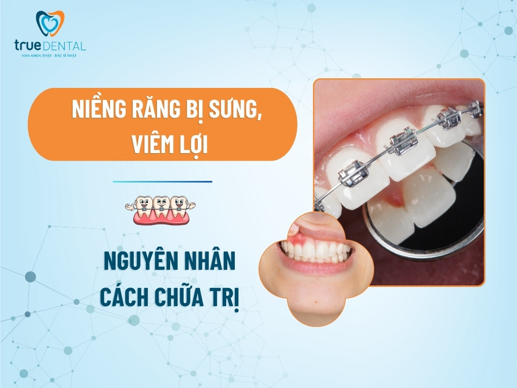 NIỀNG RĂNG BỊ SƯNG, VIÊM LỢI: NGUYÊN NHÂN VÀ CÁCH CHỮA TRỊ