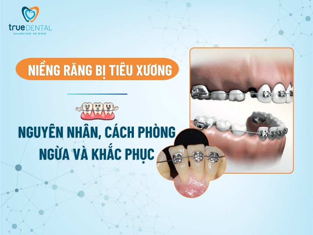 NIỀNG RĂNG BỊ TIÊU XƯƠNG: NGUYÊN NHÂN, CÁCH PHÒNG NGỪA VÀ KHẮC PHỤC
