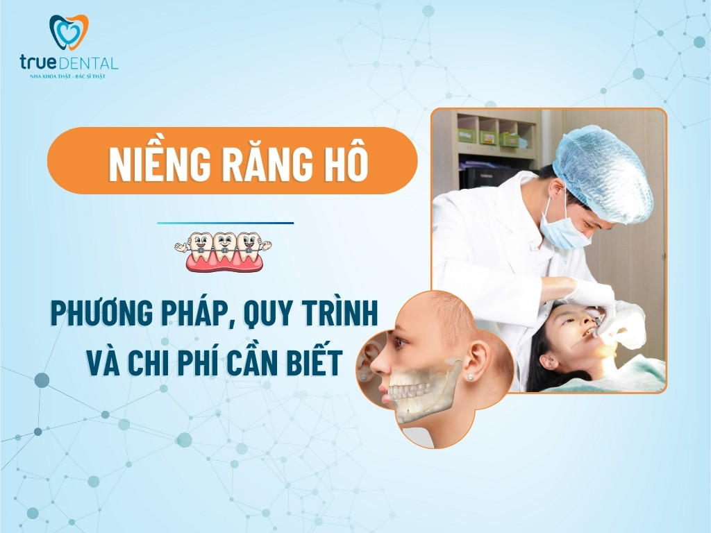 NIỀNG RĂNG HÔ: PHƯƠNG PHÁP, QUY TRÌNH VÀ CHI PHÍ CẦN BIẾT 5 NIỀNG RĂNG HÔ: PHƯƠNG PHÁP, QUY TRÌNH VÀ CHI PHÍ CẦN BIẾT