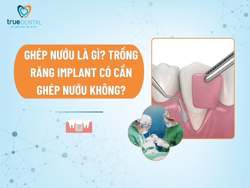 GHÉP NƯỚU LÀ GÌ? TRỒNG RĂNG IMPLANT CÓ CẦN GHÉP NƯỚU KHÔNG?