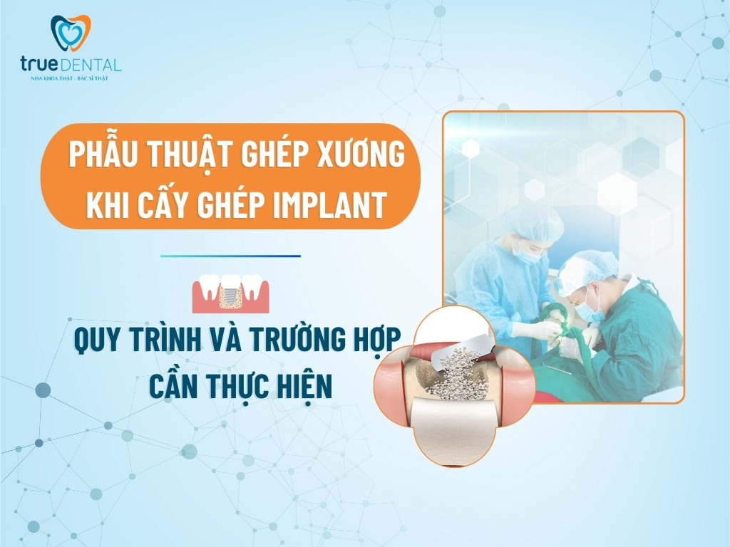 PHẪU THUẬT GHÉP XƯƠNG KHI CẤY GHÉP IMPLANT: QUY TRÌNH VÀ TRƯỜNG HỢP CẦN THỰC HIỆN