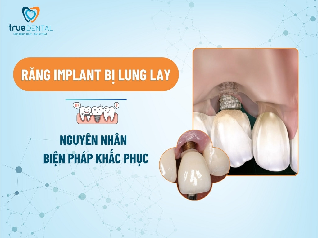 RĂNG IMPLANT BỊ LUNG LAY: NGUYÊN NHÂN VÀ BIỆN PHÁP KHẮC PHỤC