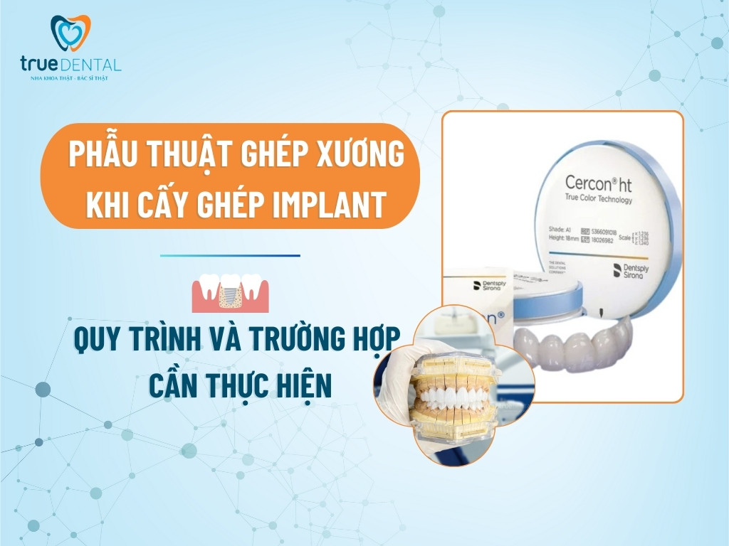 RĂNG SỨ CERCON LÀ GÌ? XUẤT XỨ VÀ NHỮNG ƯU ĐIỂM CẦN BIẾT