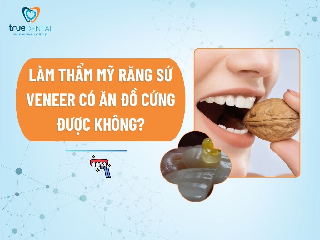 [GIẢI ĐÁP] LÀM THẨM MỸ RĂNG SỨ VENEER CÓ ĂN ĐỒ CỨNG ĐƯỢC KHÔNG?
