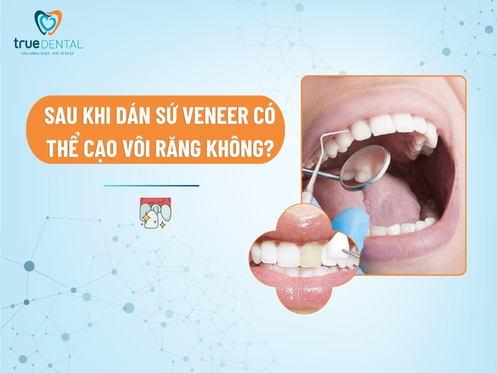 [GIẢI ĐÁP] SAU KHI DÁN SỨ VENEER CÓ THỂ CẠO VÔI RĂNG KHÔNG?