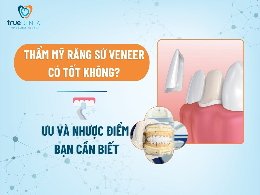 THẨM MỸ RĂNG SỨ VENEER CÓ TỐT KHÔNG? ƯU VÀ NHƯỢC ĐIỂM BẠN CẦN BIẾT