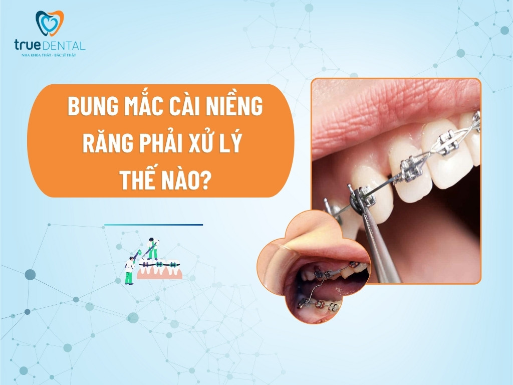 [GIẢI ĐÁP] BUNG MẮC CÀI NIỀNG RĂNG PHẢI XỬ LÝ THẾ NÀO?