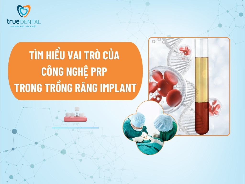 TÌM HIỂU VAI TRÒ CỦA CÔNG NGHỆ PRP TRONG TRỒNG RĂNG IMPLANT