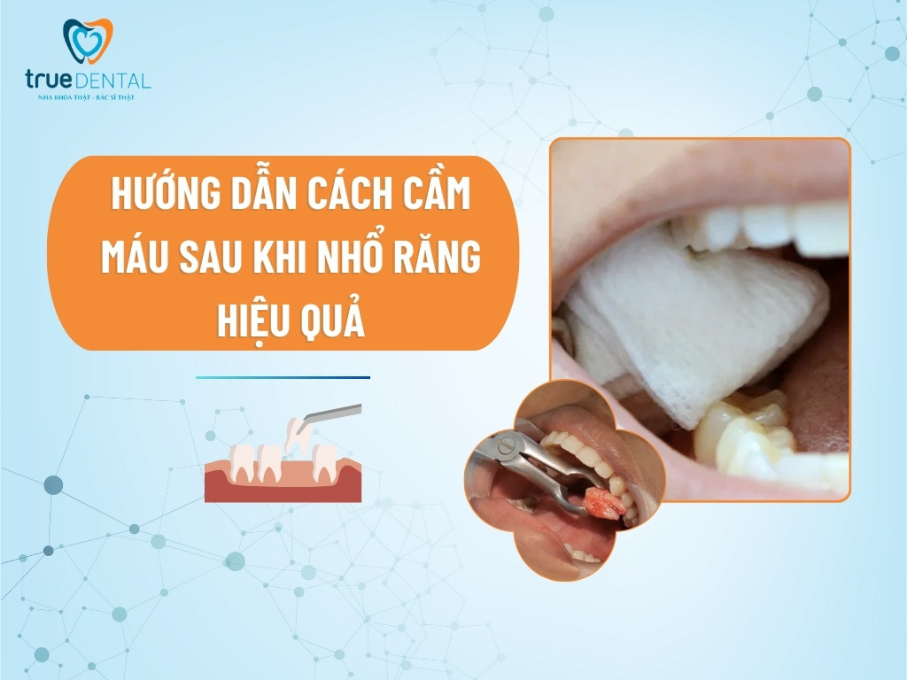 HƯỚNG DẪN CÁCH CẦM MÁU SAU KHI NHỔ RĂNG HIỆU QUẢ