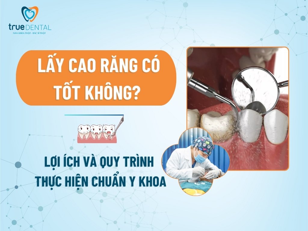 LẤY CAO RĂNG CÓ TỐT KHÔNG? LỢI ÍCH VÀ QUY TRÌNH THỰC HIỆN CHUẨN Y KHOA