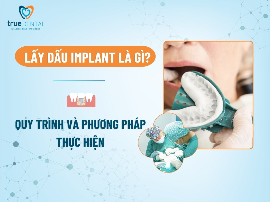 LẤY DẤU IMPLANT LÀ GÌ? QUY TRÌNH VÀ PHƯƠNG PHÁP THỰC HIỆN