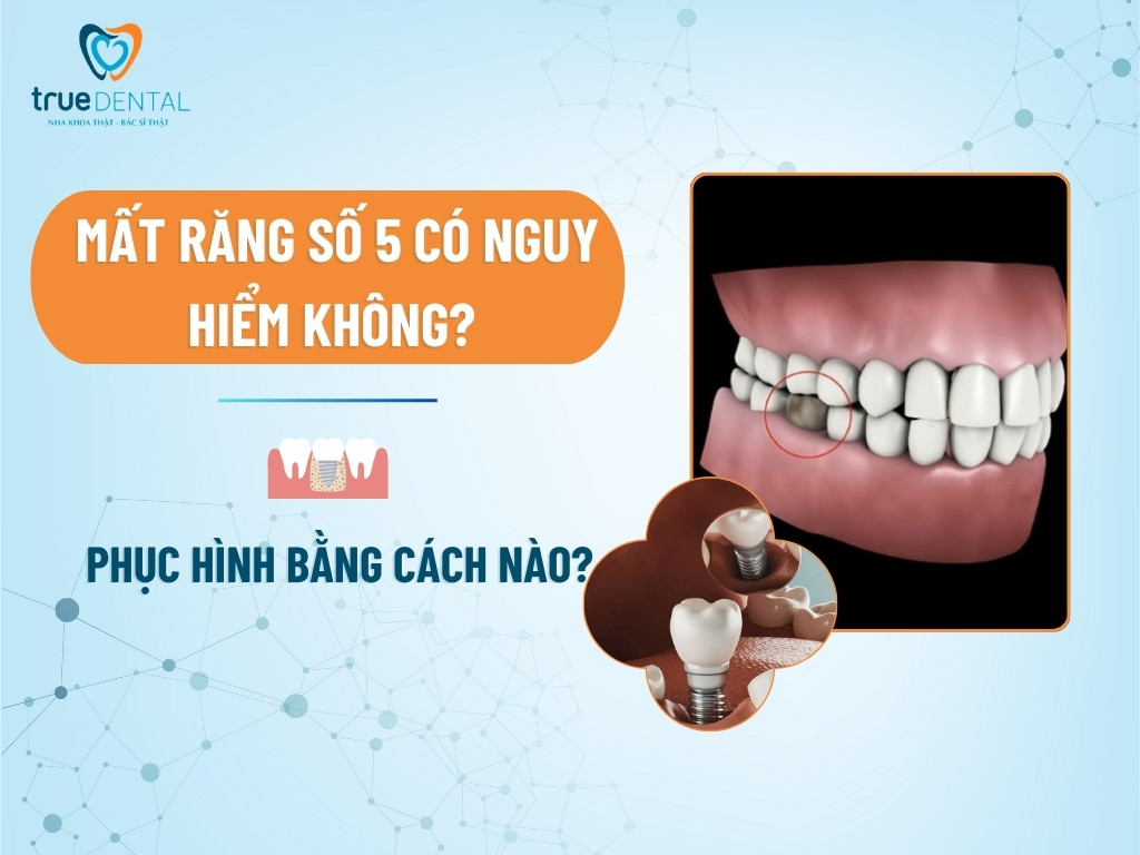 [GIẢI ĐÁP] MẤT RĂNG SỐ 5 CÓ NGUY HIỂM KHÔNG? PHỤC HÌNH BẰNG CÁCH NÀO?