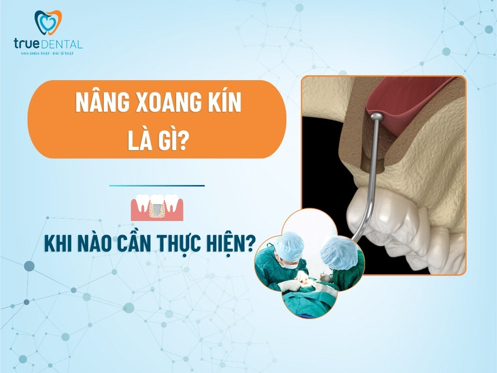 NÂNG XOANG KÍN LÀ GÌ? KHI NÀO CẦN THỰC HIỆN?