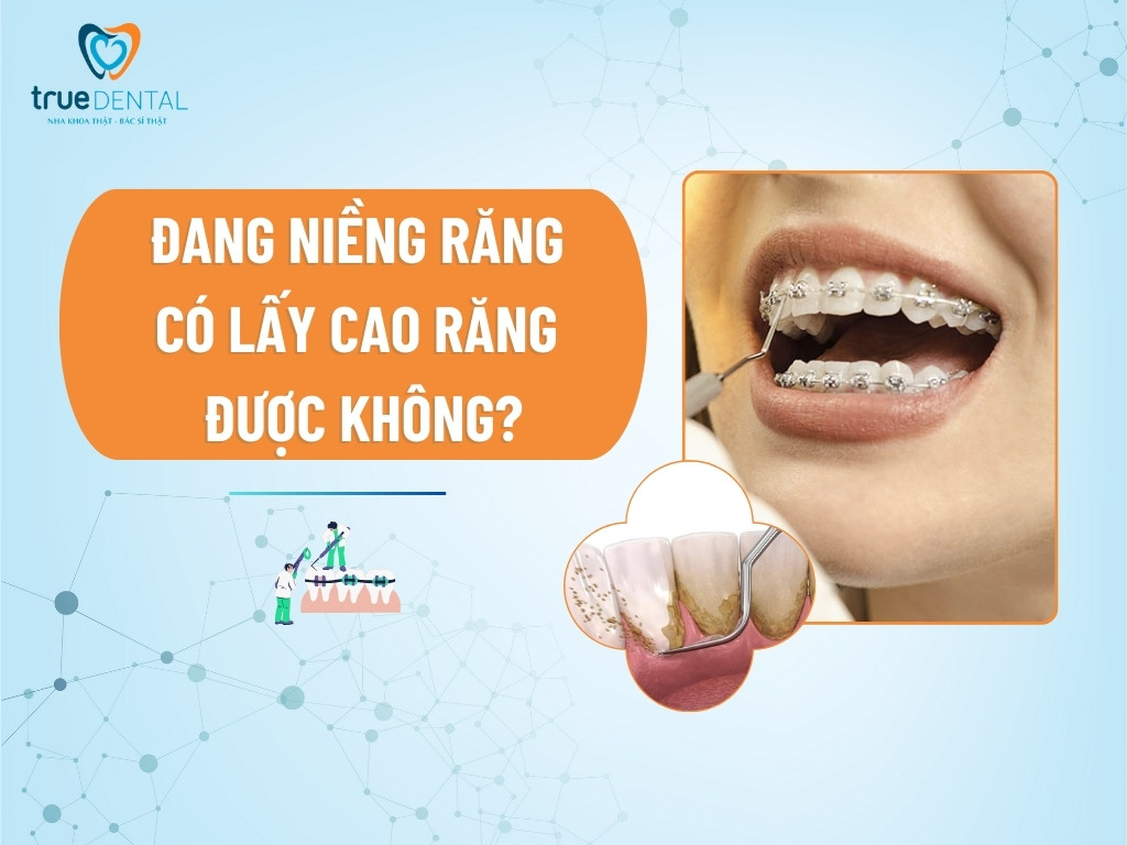 [GIẢI ĐÁP] ĐANG NIỀNG RĂNG CÓ LẤY CAO RĂNG ĐƯỢC KHÔNG?