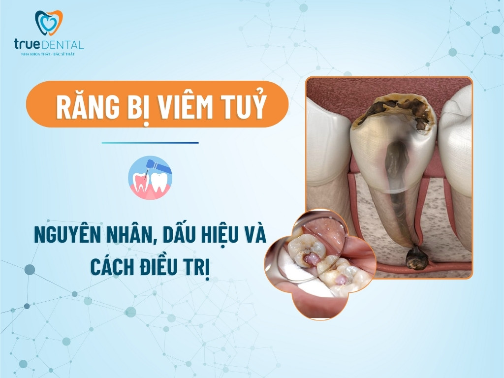 Viêm tủy răng: Dấu hiệu, nguyên nhân, cách phòng ngừa 5 RĂNG BỊ VIÊM TUỶ: NGUYÊN NHÂN, DẤU HIỆU NHẬN BIẾT VÀ CÁCH ĐIỀU TRỊ
