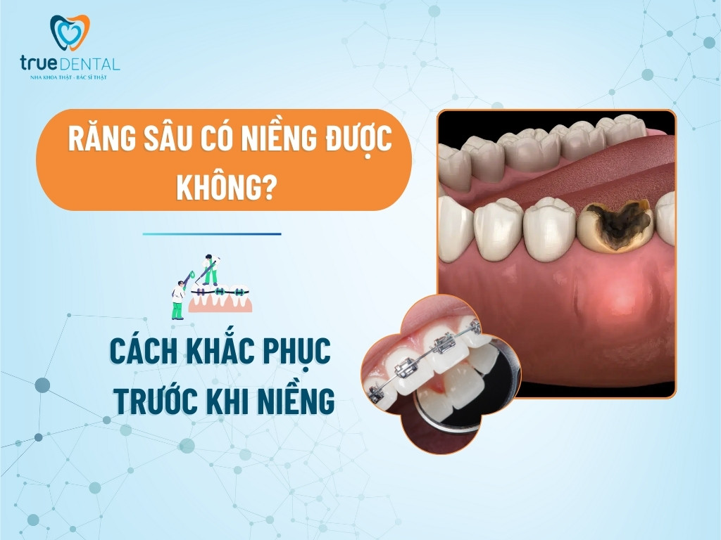 [GIẢI ĐÁP] RĂNG SÂU CÓ NIỀNG ĐƯỢC KHÔNG? CÁCH KHẮC PHỤC TRƯỚC KHI NIỀNG