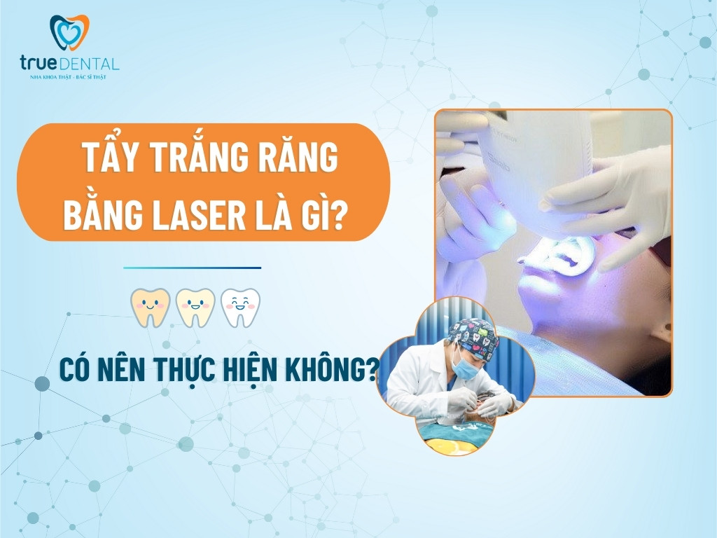 TẨY TRẮNG RĂNG BẰNG LASER LÀ GÌ? CÓ NÊN THỰC HIỆN KHÔNG?