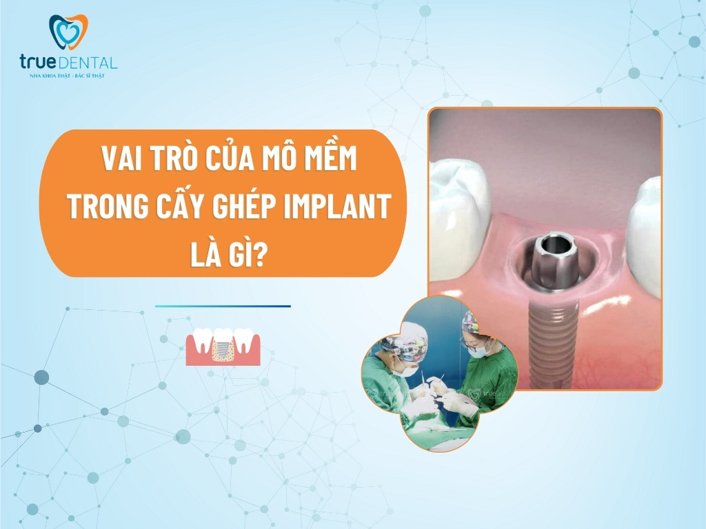 [GIẢI ĐÁP] VAI TRÒ CỦA MÔ MỀM TRONG CẤY GHÉP IMPLANT LÀ GÌ?