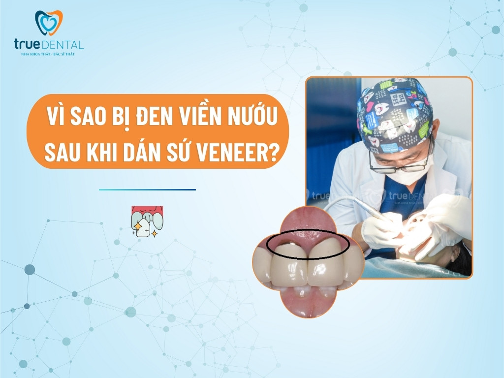 [GIẢI ĐÁP] VÌ SAO BỊ ĐEN VIỀN NƯỚU SAU KHI DÁN SỨ VENEER?