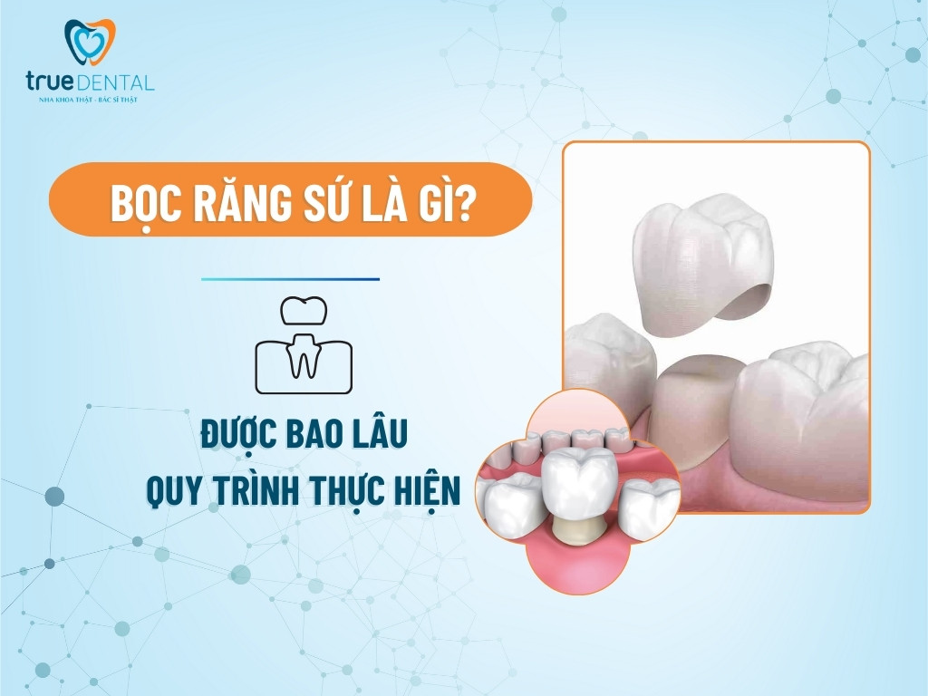 Bọc răng sứ là gì? Được bao lâu, quy trình thực hiện