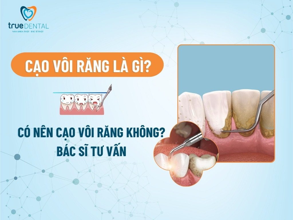 Cạo vôi răng là gì? Có nên cạo vôi răng không - Bác sĩ tư vấn
