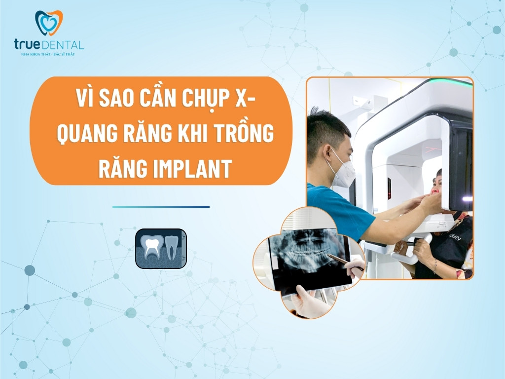 [GIẢI ĐÁP] VÌ SAO CẦN CHỤP X-QUANG RĂNG KHI TRỒNG RĂNG IMPLANT