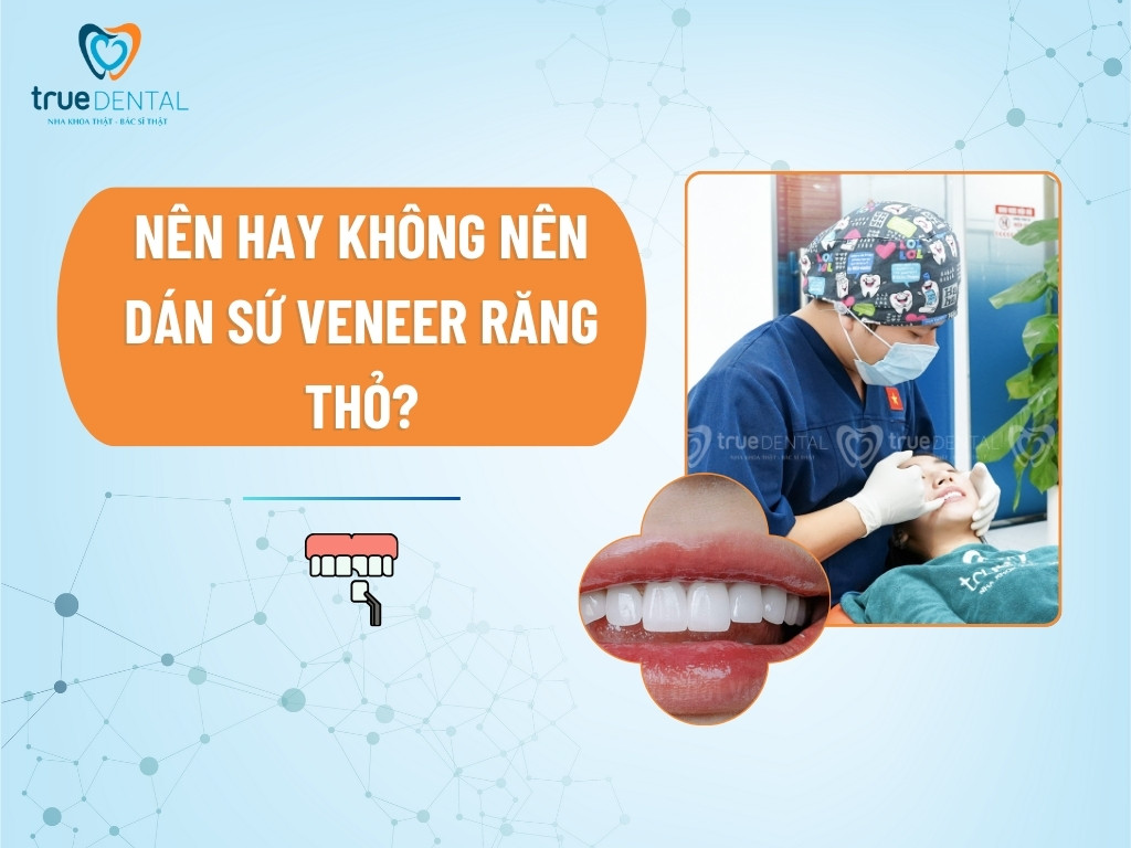 [GIẢI ĐÁP] NÊN HAY KHÔNG NÊN DÁN SỨ VENEER RĂNG THỎ?